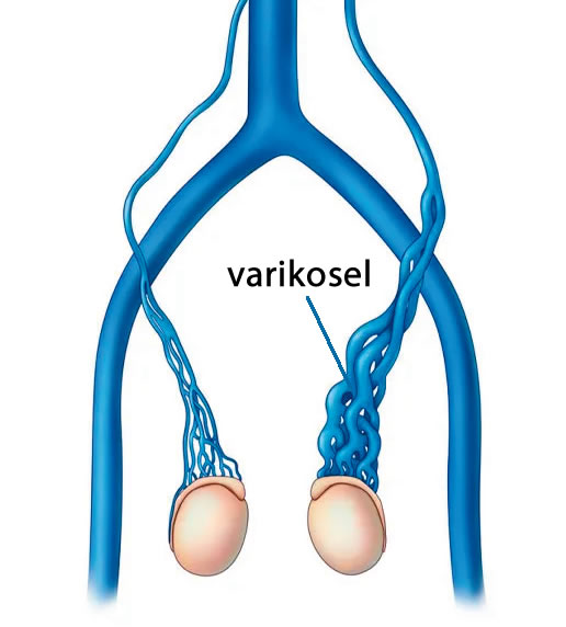 Varikosel, genellikle testislerdeki damarlarda oluşan genişlemelerdir ve erkeklerde yaygın bir