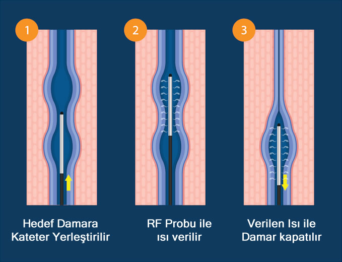 Kılcal varisler, genellikle ciltte görülen ince, mor ya da kırmızı